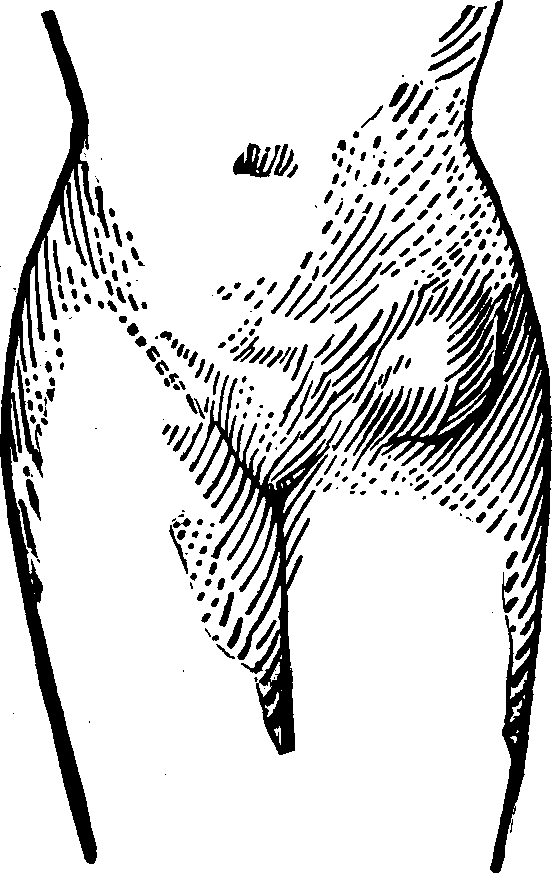 Illustration:
Fig. 2.  This figure illustrates a case of Femoral Hernia 