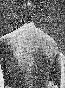 55. Lesions produced by the attacks of Pediculoides ventricosus.
After Webster.