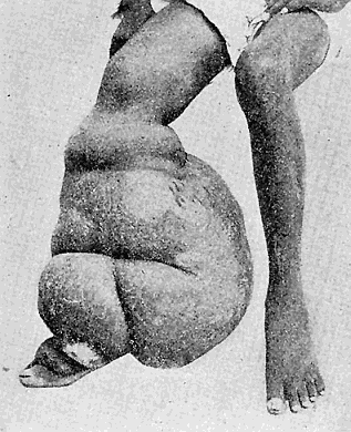 119. Elephantiasis in Man. From "New
Sydenham Society's Atlas."
