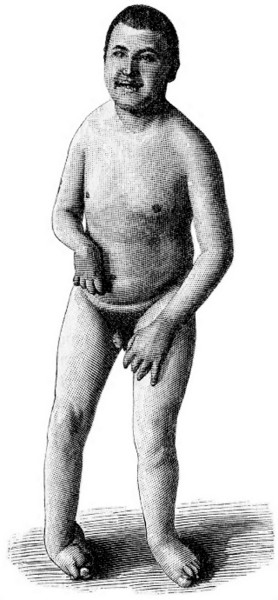 Fig. 20. Idiotismus mit zebraler Kinderl�hmung.