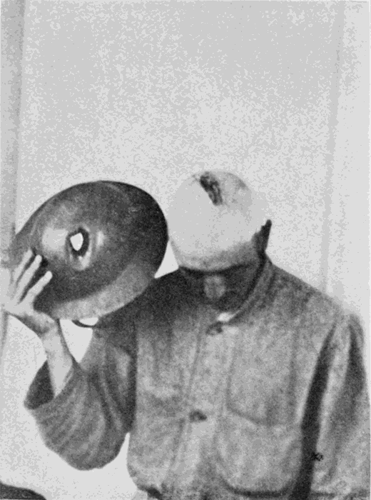 SERGT.
NICHOLSON, SHOWING HIS WOUNDED SKULL AND HELMET WORN WHEN WOUND WAS
RECEIVED